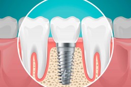 aurea-odontologia-clinica-guarulhos-implantes-dentarios-enxertos-osseos-e-reabilitacao-oral-2019-01