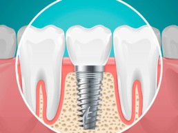 aurea-odontologia-clinica-guarulhos-implantes-dentarios-enxertos-osseos-e-reabilitacao-oral-2019-01
