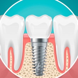 aurea-odontologia-clinica-guarulhos-implantes-dentarios-enxertos-osseos-e-reabilitacao-oral-2019-01